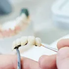 被せ物